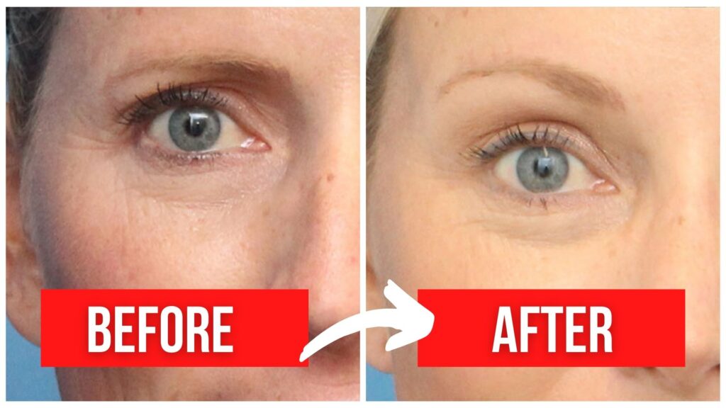 Botox Brow Lift Before And After Photo
