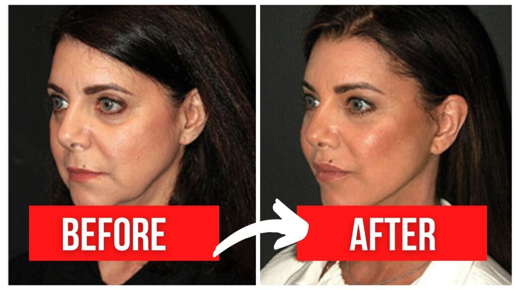 Botox BrowLift Before And After Photos