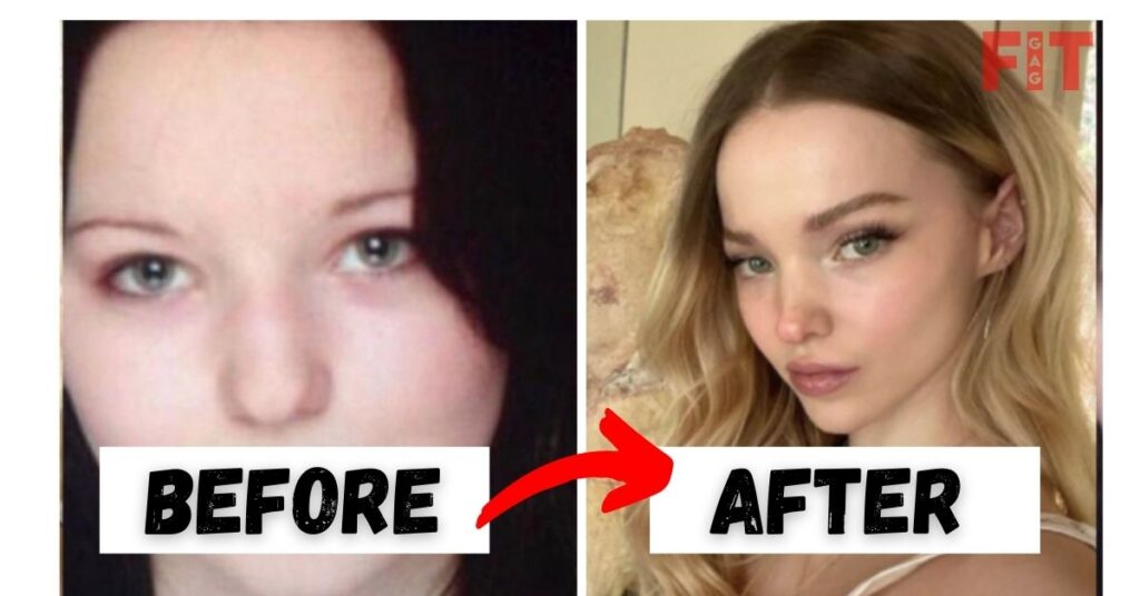 Dove Cameron's Plastic Surgery Rumors Before And After