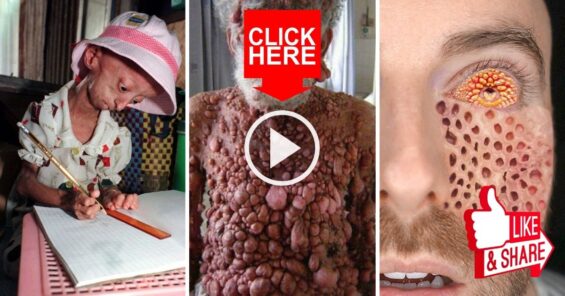 10 Mind-Blowing Weird & Mysterious Diseases That Will Leave You Baffled!